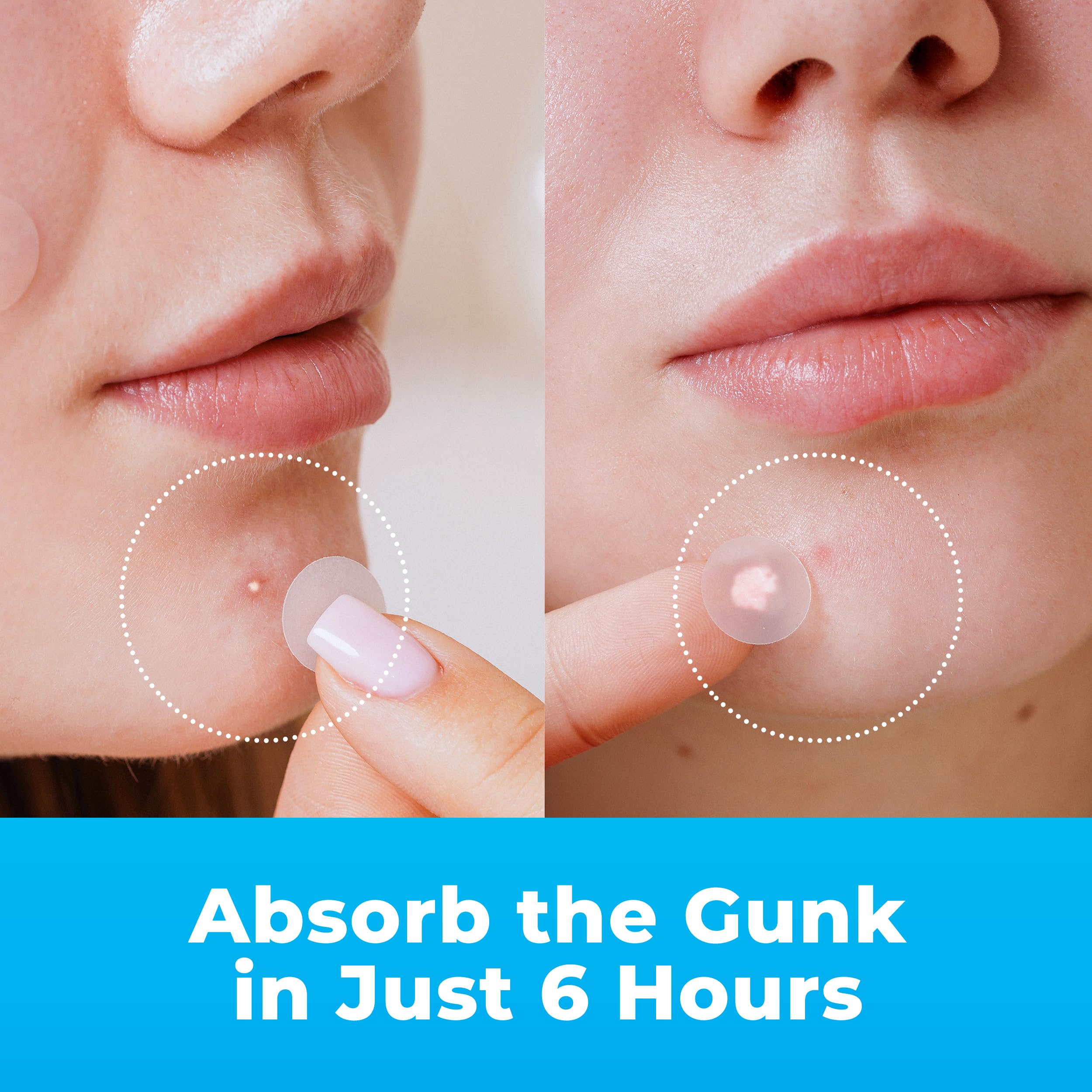 PatchRx Pimple Patches for Face (120 Patches), Hydrocolloid Acne Patches with Tea Tree Oil, Pimple Patch Pimple Stickers - Hydrocolloid Patch Acne Dots - Acne Pimple Patches For Face - Zit Patches - Image 6